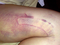 healing bruises after liposuction